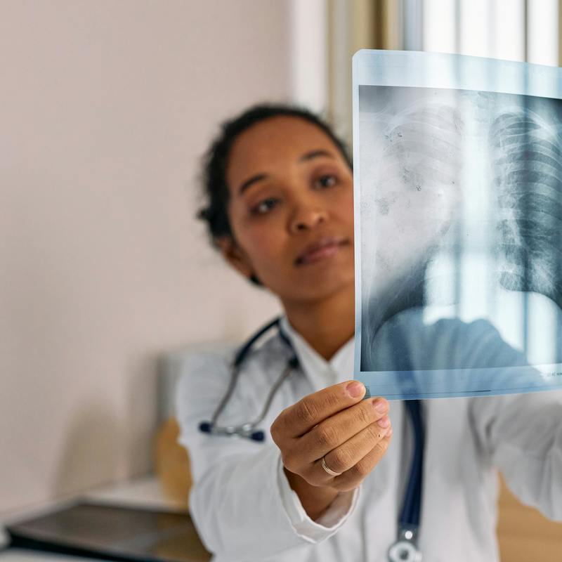 Pulmonary cystic adenomatoid malformation jpg